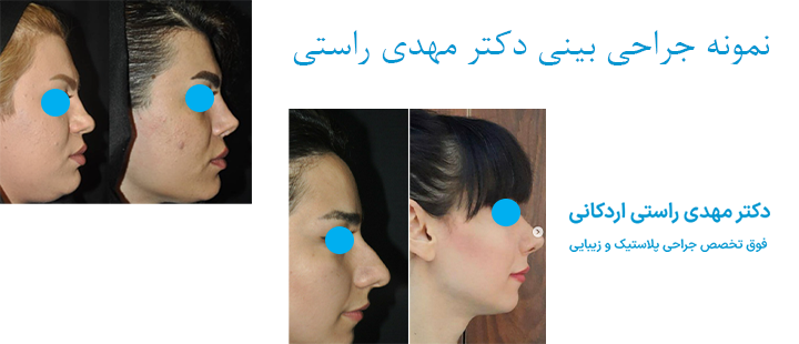 نمونه جراحی بینی دکتر راستی 