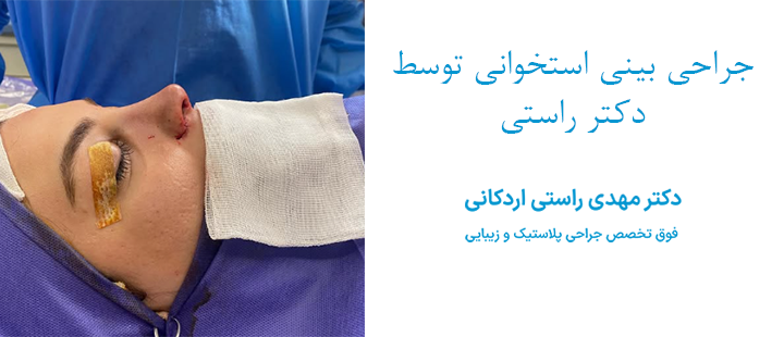 جراحی بینی استخوانی توسط دکتر راستی 