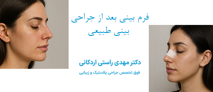 فرم بینی بعد از جراحی بینی طبیعی