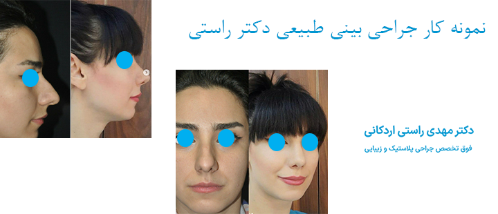 نمونه کار جراحی بینی طبیعی دکتر راستی 