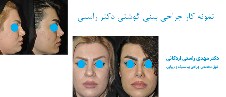 نمونه کار جراحی بینی گوشتی دکتر راستی 