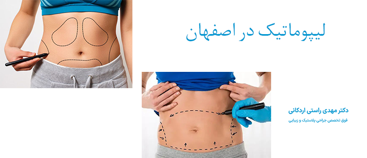 درباره لیپوماتیک در اصفهان 