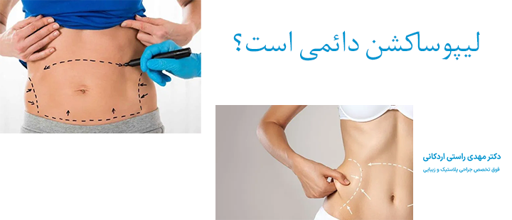  لیپوساکشن  دائمی است؟