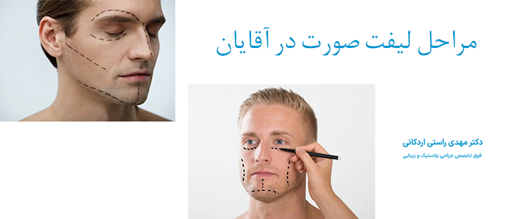 مراحل لیفت صورت در آقایان 