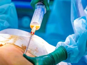 بهترین دکتر لیپوماتیک