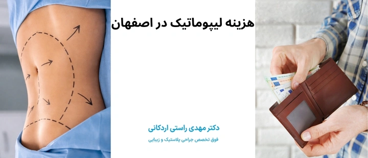 هزینه لیپوماتیک در اصفهان