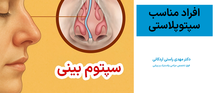افراد مناسب سپتوپلاستی