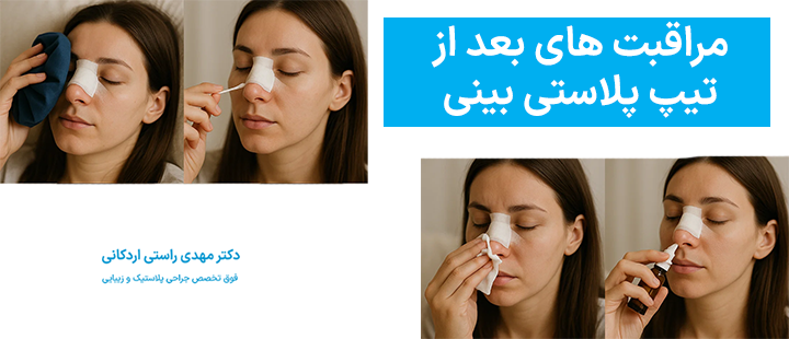 مراقبت های بعد از تیپ پلاستی بینی