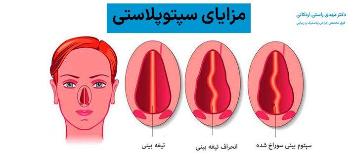 مزایای سپتوپلاستی