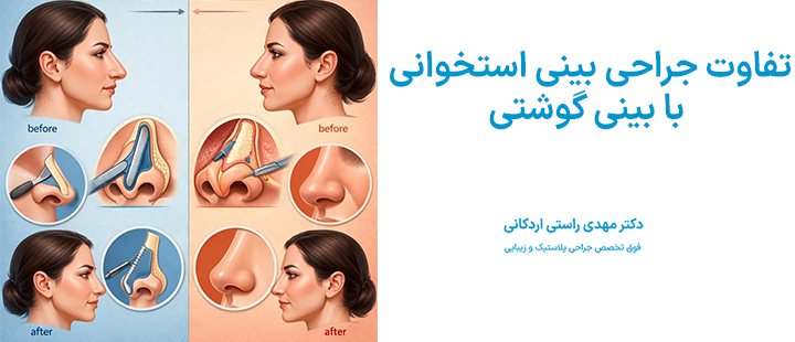 تفاوت جراحی بینی استخوانی با بینی گوشتی